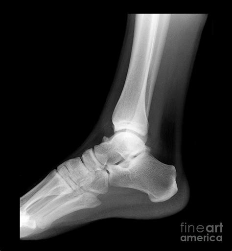 11 Year Old Ankle X Ray