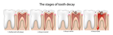 The 5 Stages of Tooth Decay | News | Dentagama