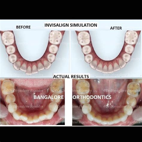 Before and After| Invisalign| Crowded, misaligned teeth correction in 3 months – Bangalore ...