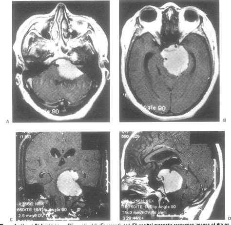 Figure 1 from Petroclival Meningioma | Semantic Scholar