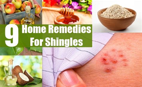 9 Home remedies for Shingles - Vistasol Medical Group