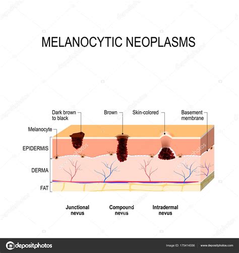 Melanocytic nevus — Stock Vector © edesignua #175414556