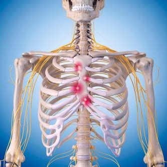 Costochondritis - Physiopedia