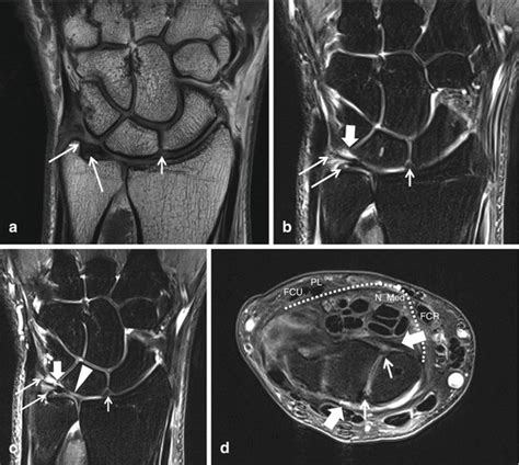 Ulnar Collateral Ligament Wrist Mri