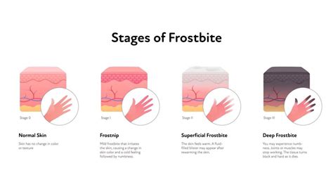 Frostbite Symptoms and Treatment