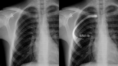 Chest X-ray - Anatomical variants - Rib variants