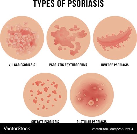 Psoriasis skin disease types of derma problem Vector Image