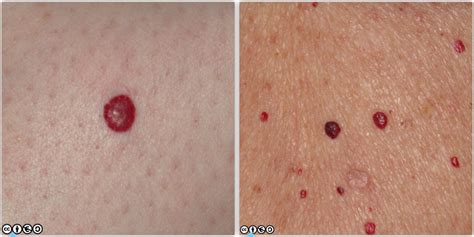 Red Spots On Skin Cancer