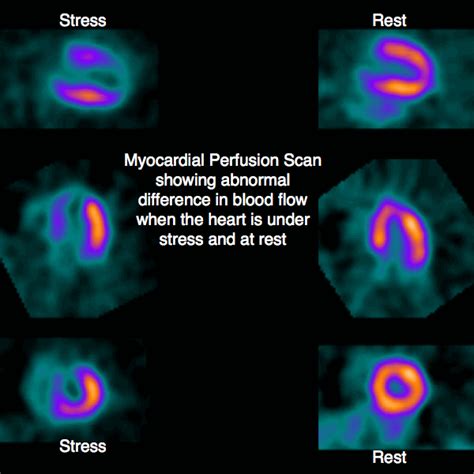 Myocardial Perfusion Scan - Heart of England Cardiology