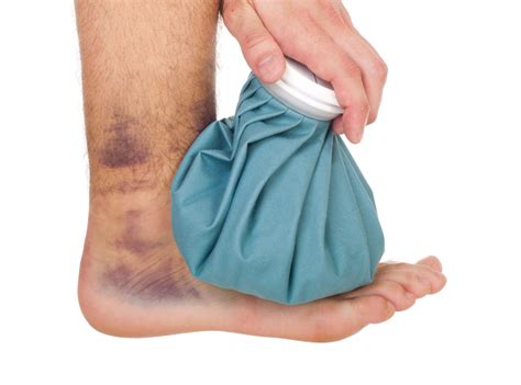 Icing a sprained ankle - Sarum Physio | Salisbury's premier physio and sports injuries clinic