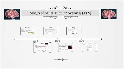 Stages of Acute Tubular Necrosis (ATN) by Mara Shapero on Prezi