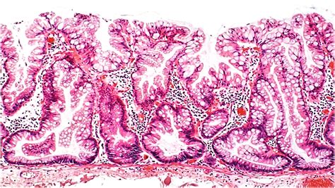 Sessile Serrated Adenoma Histology