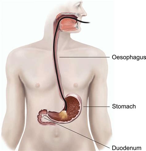 Upper GI endoscopy and dilatation | healthdirect