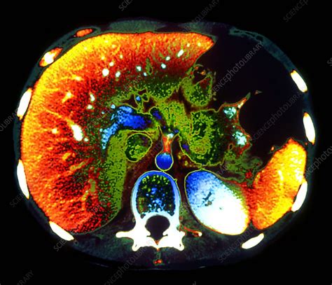 Liver Ct Scan