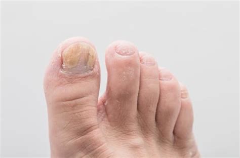 Is Athlete’s Foot Related to Toenail Fungus?