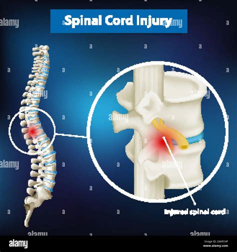 Diagram showing spinal cord injury illustration Stock Vector Image & Art - Alamy