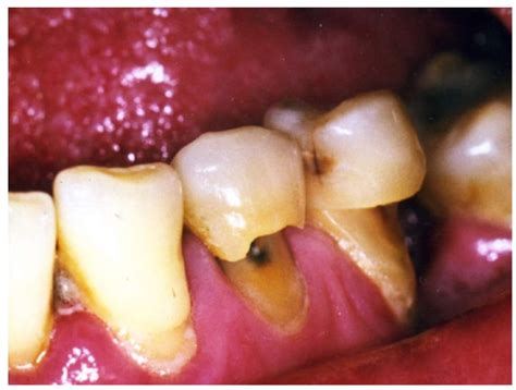 Tooth Abrasion Vs Erosion