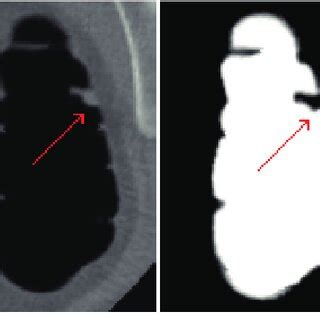 The VOI extraction for a 6 mm sessile polyp in a sigmoid colon. a) The... | Download Scientific ...