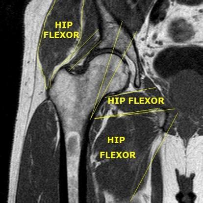 Hip Flexor Strain: Signs, Causes, Treatment and Recovery | IYTmed.com