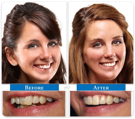 six month smiles before and after - guerradental.com