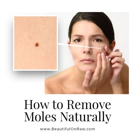 Skin Moles … Removal and Prevention | Beautiful on Raw | Skin moles ...