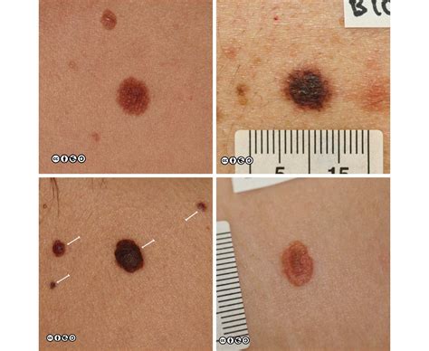 Melanoma Skin Cancer Stages