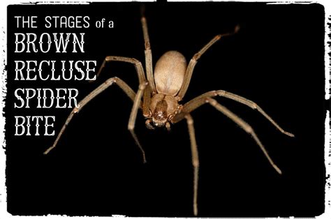 Pictures, Symptoms, and Treatment of Black Widow Spider Bites | HubPages