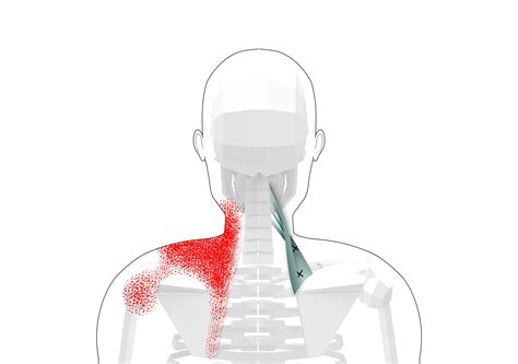 Levator Scapulae Trigger Points (Overview - Self Treatment Tips)