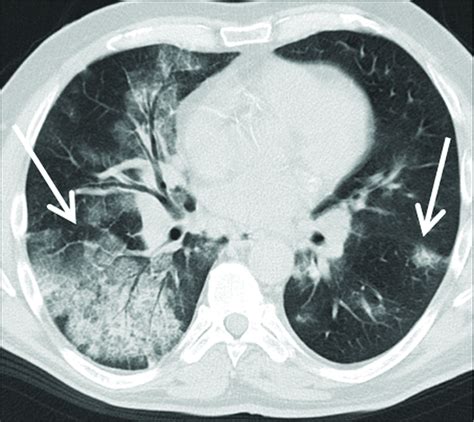 The many faces of cryptogenic organizing pneumonia (COP) - Journal of Clinical Imaging Science