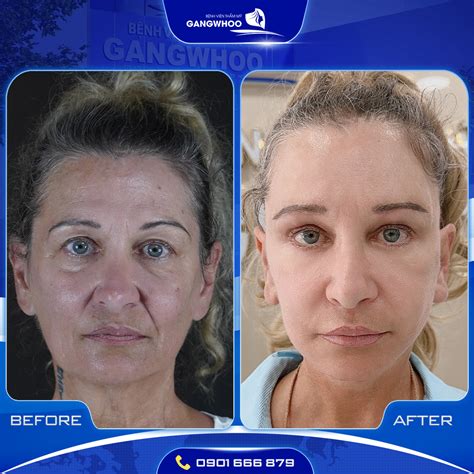 SMAS FACELIFT - LIFE-CHANGING RESULT AFTER ONLY 1 AMAZING PROCEDURE