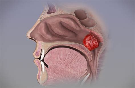 Adenoidectomia