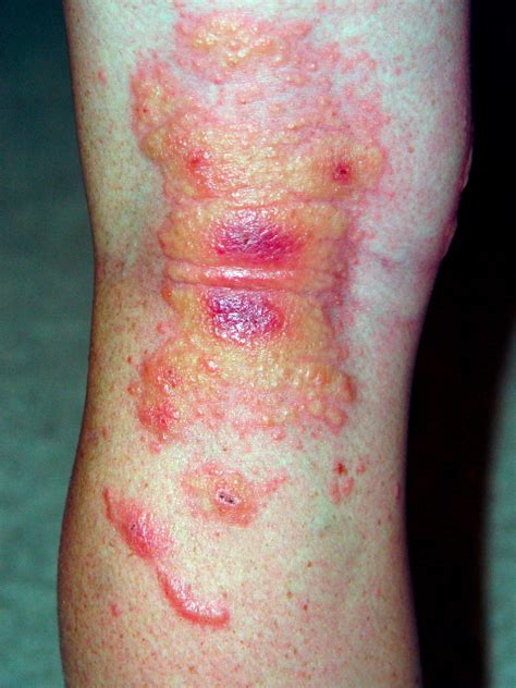 poison ivy rashes and blisters - Gallery | eBaum's World