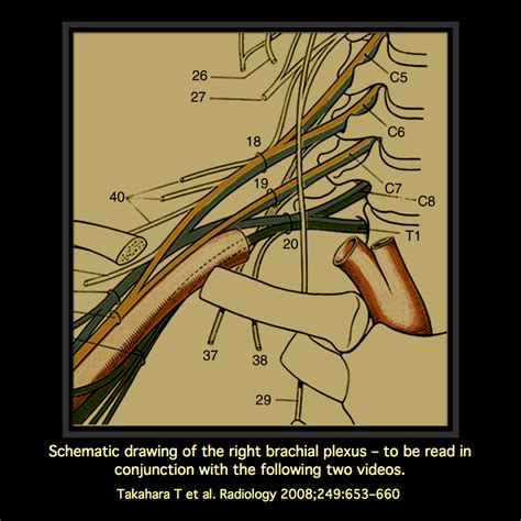 MRI BLOG: Brachial Plexus MRI (I/II)