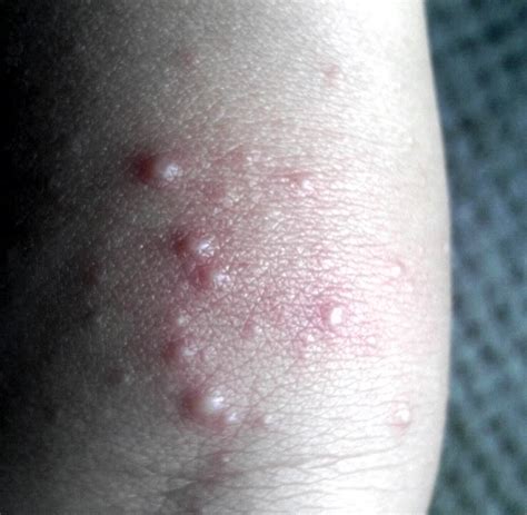 Itchy Rash On Back Of Knees