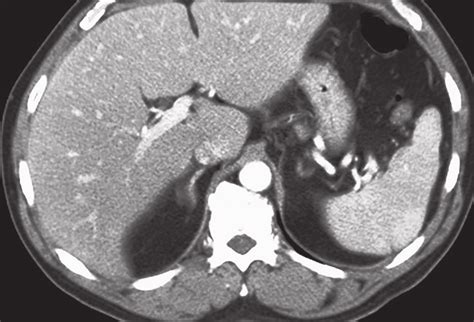 CT scan of the abdomen after recovery shows a normal spleen | Download Scientific Diagram