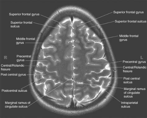 Introduction to Brain Imaging | Radiology Key