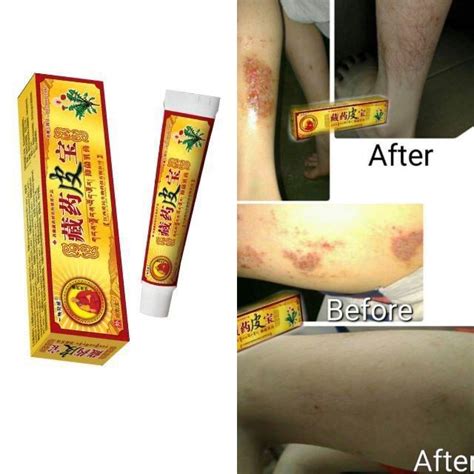 Eczema Treatment Anti Bacterial skin Fungus Cream 15g Untuk 9 kes pembaikan, tangan dan kaki ...