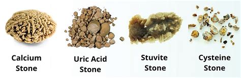 KIDNEY STONES JUST THE FACTS | IMAGE Magazine