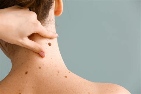 Seborrheic Keratosis Back