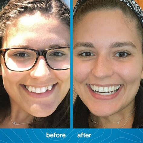 Invisalign Before and After PhotosDr. Jacquie Monroe Ortho