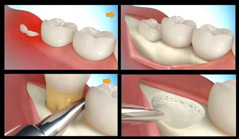 Wisdom tooth surgical removal | Teeth Extraction | Treatment infected wisdom | IV sedation ...