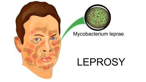 Leprosy - Symptoms, Treatment, Pathophysiology