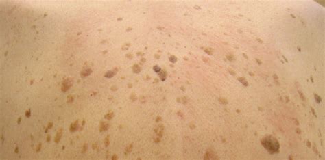 Seborrheic Keratosis Back