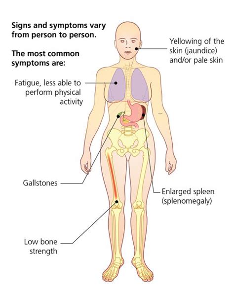 Alpha Thalassemia: Symptoms and Treatment - The Waiting Room