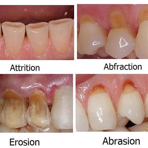 DIFFERENCE BETWEEN ABFRACTION, ABRASION, EROSION AND ATTRITION | The ...