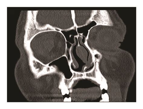 Right globe rupture on nonenhanced CT scan of the orbits. | Download Scientific Diagram