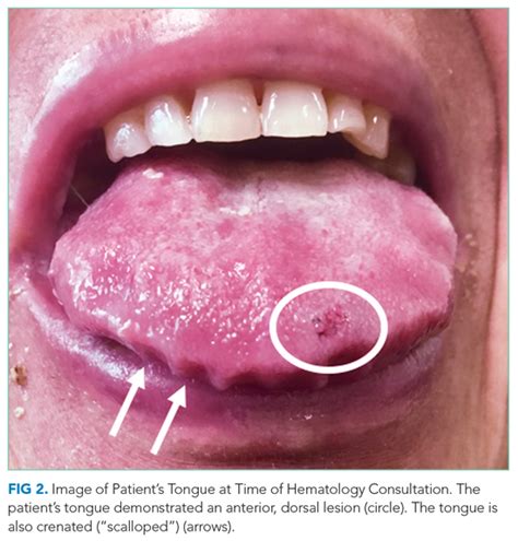 Tongue Disease