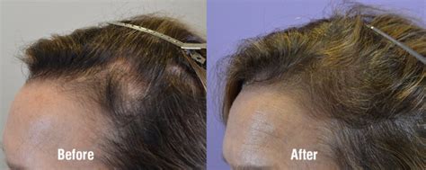 Rogaine Hair Restoration Results - Hair Restoration of the South