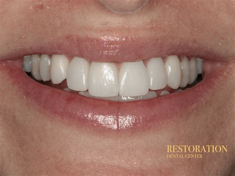 Before & After Gallery | Restoration Dental Center | United States