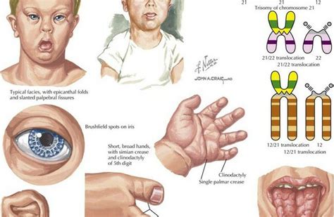 Symptoms of Trisomy 21 (Down Syndrome) – Healthy Food Near Me